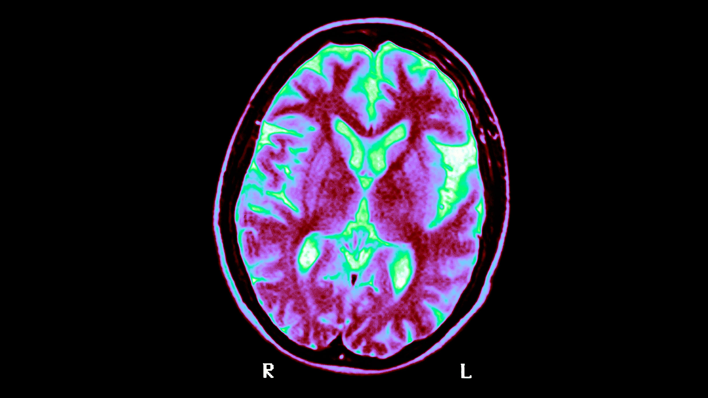 Billede fra hjernescanning. Foto: BSIP/Getty Images